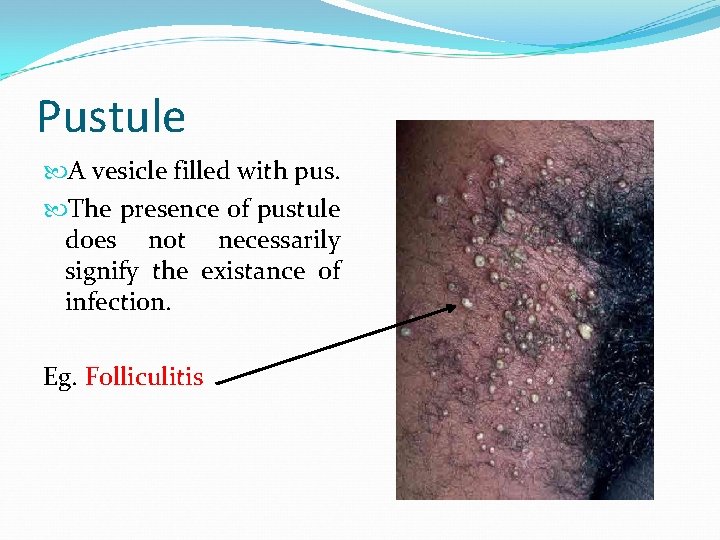 Pustule A vesicle filled with pus. The presence of pustule does not necessarily signify