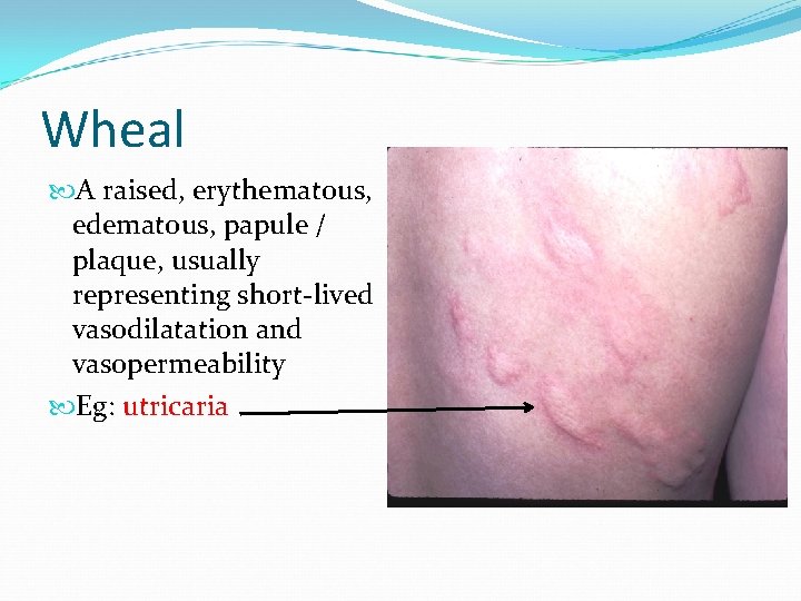 Wheal A raised, erythematous, edematous, papule / plaque, usually representing short-lived vasodilatation and vasopermeability