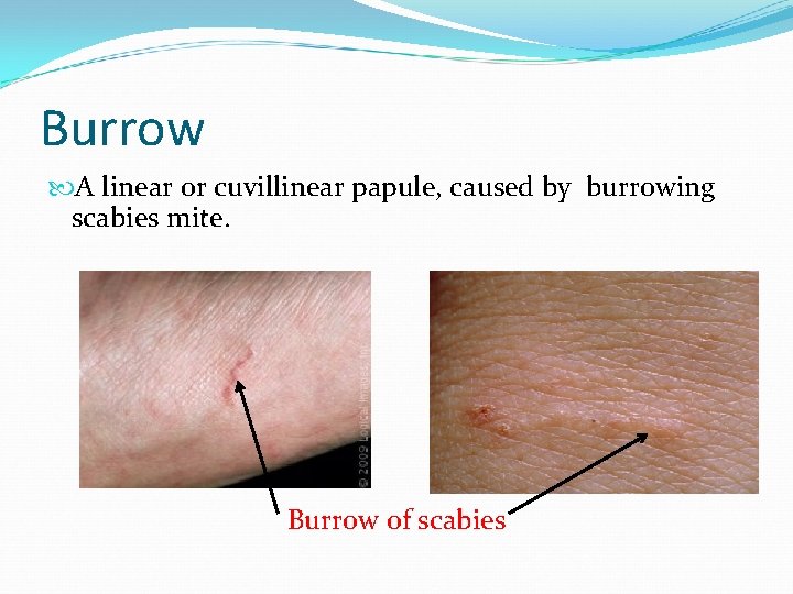 Burrow A linear or cuvillinear papule, caused by burrowing scabies mite. Burrow of scabies
