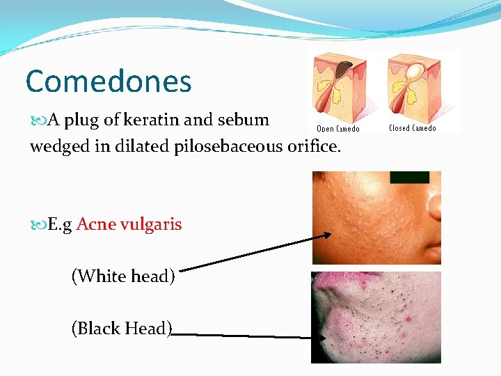 Comedones A plug of keratin and sebum wedged in dilated pilosebaceous orifice. E. g
