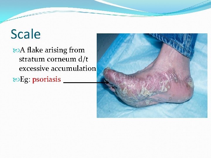 Scale A flake arising from stratum corneum d/t excessive accumulation. Eg: psoriasis 