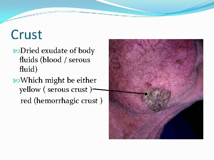 Crust Dried exudate of body fluids (blood / serous fluid) Which might be either