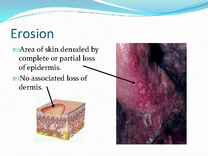 Erosion Area of skin denuded by complete or partial loss of epidermis. No associated