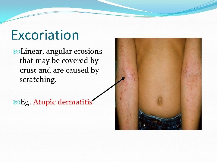 Excoriation Linear, angular erosions that may be covered by crust and are caused by