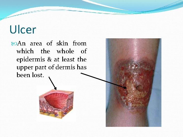 Ulcer An area of skin from which the whole of epidermis & at least