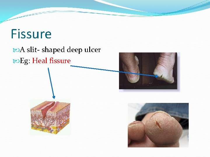 Fissure A slit- shaped deep ulcer Eg: Heal fissure 