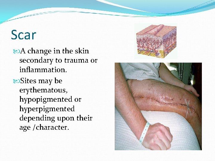Scar A change in the skin secondary to trauma or inflammation. Sites may be
