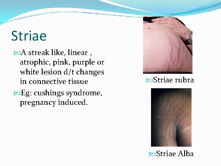 Striae A streak like, linear , atrophic, pink, purple or white lesion d/t changes