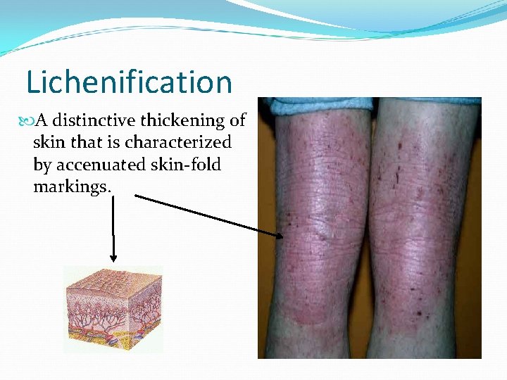 Lichenification A distinctive thickening of skin that is characterized by accenuated skin-fold markings. 