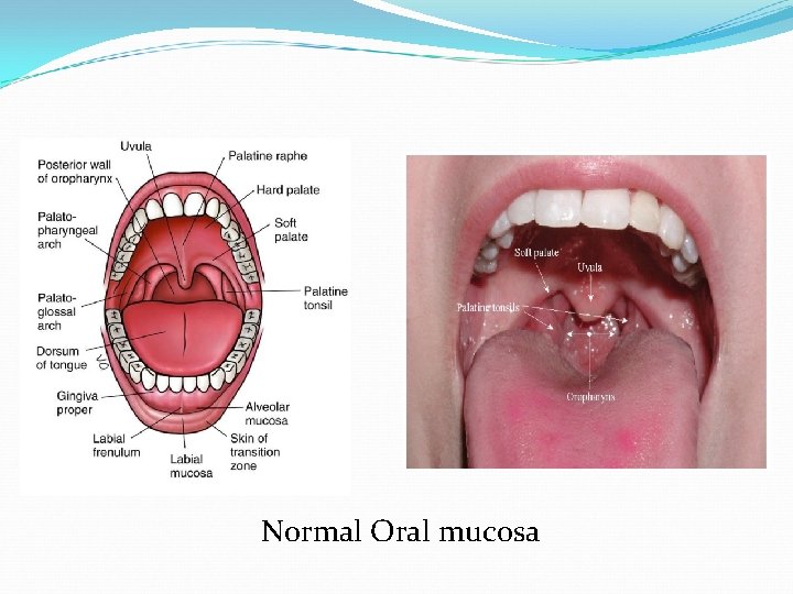 Normal Oral mucosa 