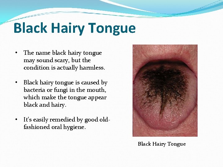 Black Hairy Tongue • The name black hairy tongue may sound scary, but the