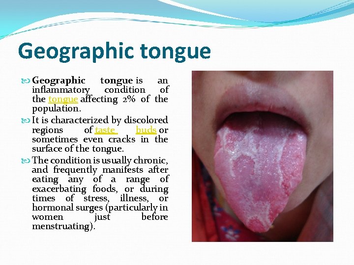 Geographic tongue is an inflammatory condition of the tongue affecting 2% of the population.