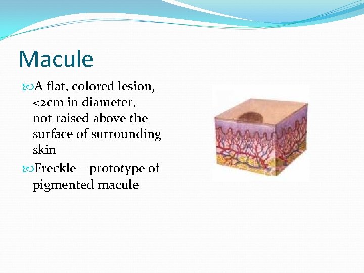 Macule A flat, colored lesion, <2 cm in diameter, not raised above the surface