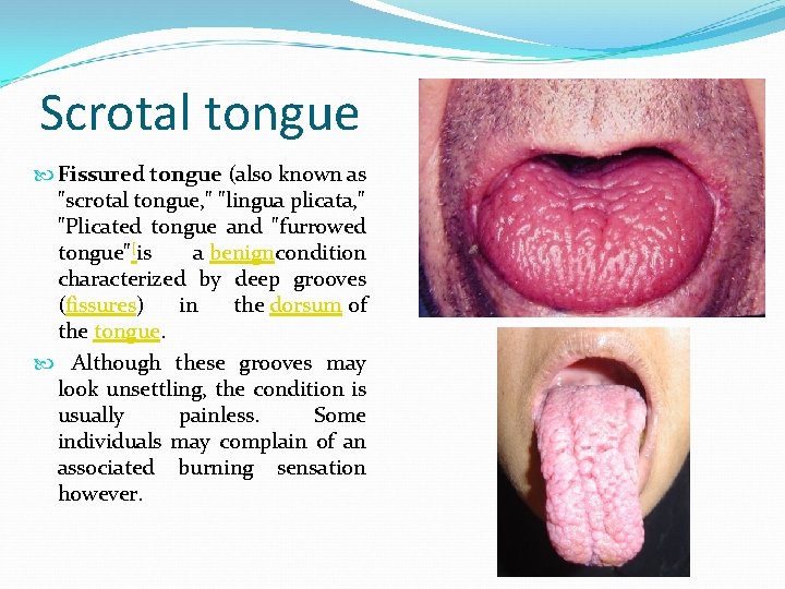 Scrotal tongue Fissured tongue (also known as "scrotal tongue, " "lingua plicata, " "Plicated