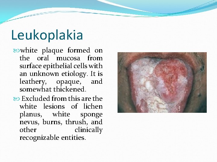 Leukoplakia white plaque formed on the oral mucosa from surface epithelial cells with an
