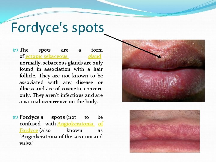 Fordyce's spots The spots are a form of ectopic sebaceous gland: normally, sebaceous glands
