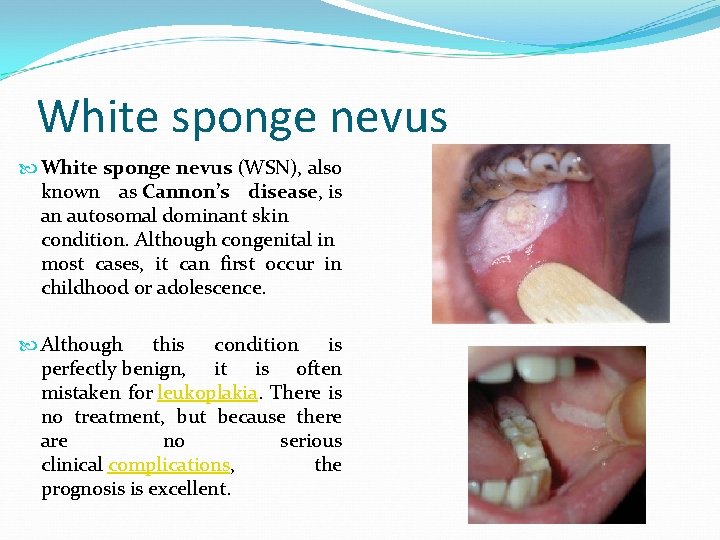 White sponge nevus (WSN), also known as Cannon’s disease, is an autosomal dominant skin