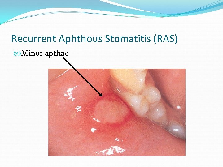 Recurrent Aphthous Stomatitis (RAS) Minor apthae 