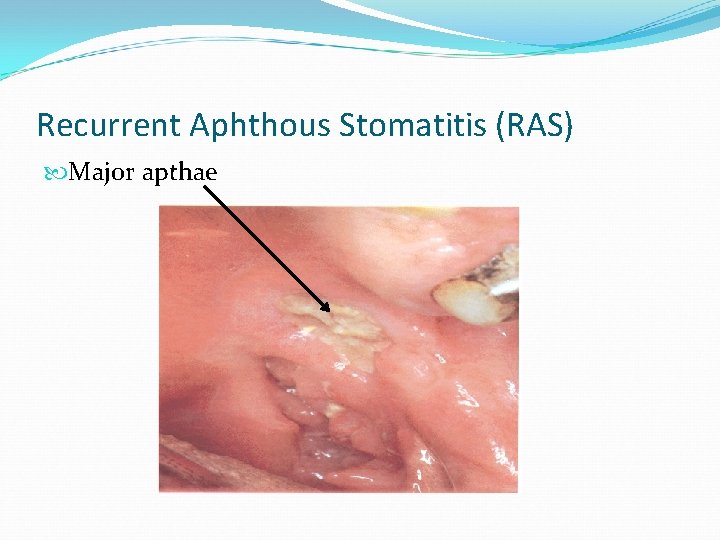 Recurrent Aphthous Stomatitis (RAS) Major apthae 