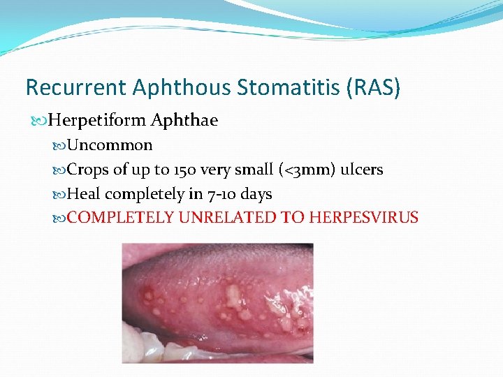 Recurrent Aphthous Stomatitis (RAS) Herpetiform Aphthae Uncommon Crops of up to 150 very small