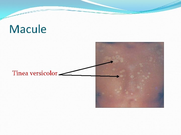 Macule Tinea versicolor 
