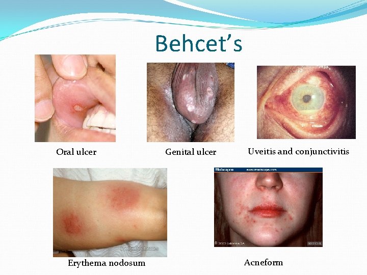Behcet’s Oral ulcer Erythema nodosum Genital ulcer Uveitis and conjunctivitis Acneform 