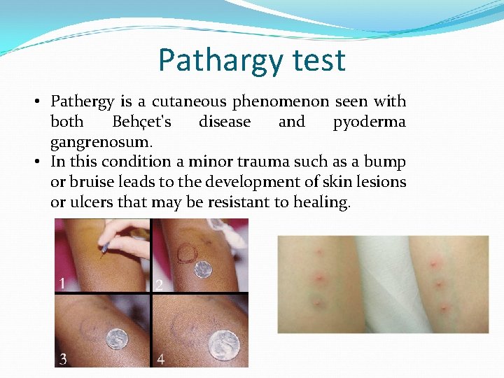 Pathargy test • Pathergy is a cutaneous phenomenon seen with both Behçet's disease and