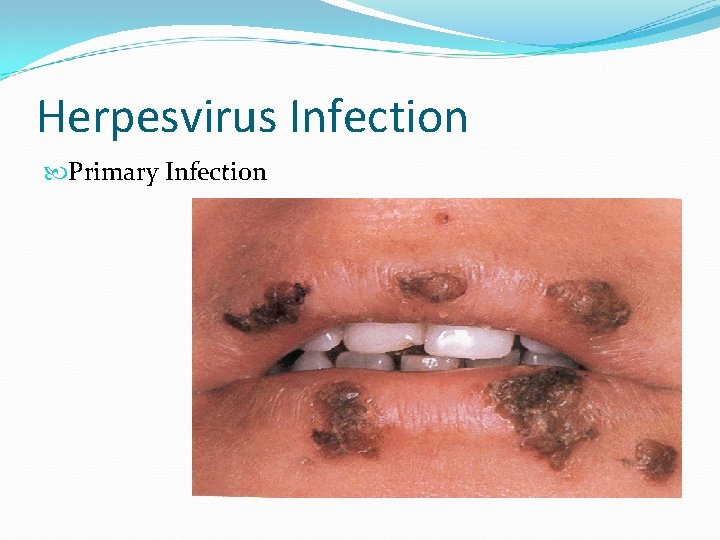 Herpesvirus Infection Primary Infection 