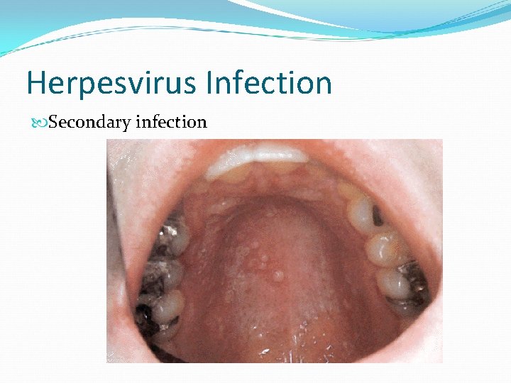 Herpesvirus Infection Secondary infection 