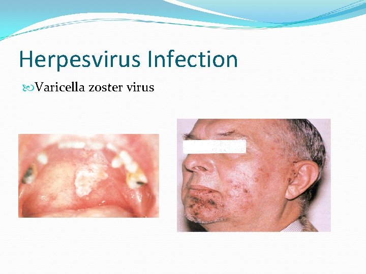 Herpesvirus Infection Varicella zoster virus 