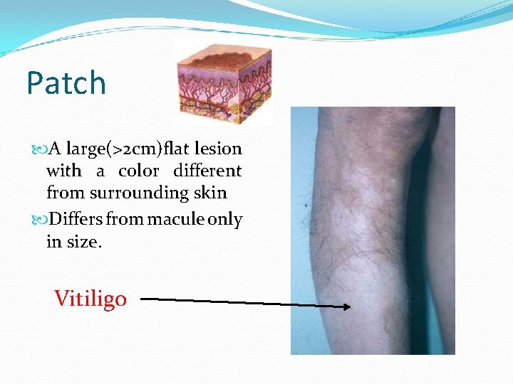Patch A large(>2 cm)flat lesion with a color different from surrounding skin Differs from