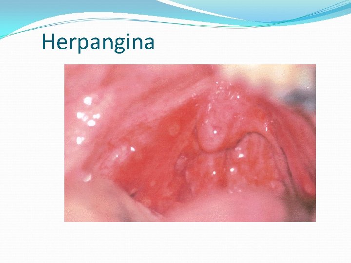 Herpangina 