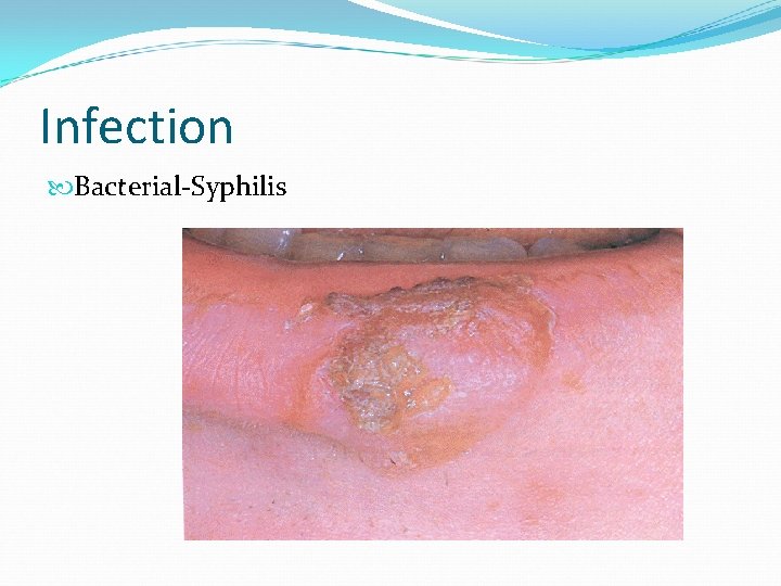 Infection Bacterial-Syphilis 