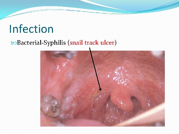 Infection Bacterial-Syphilis (snail track ulcer) 