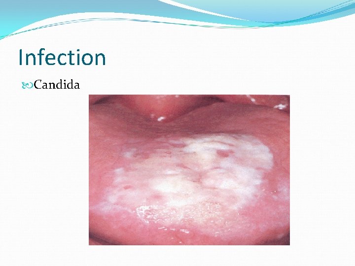 Infection Candida 