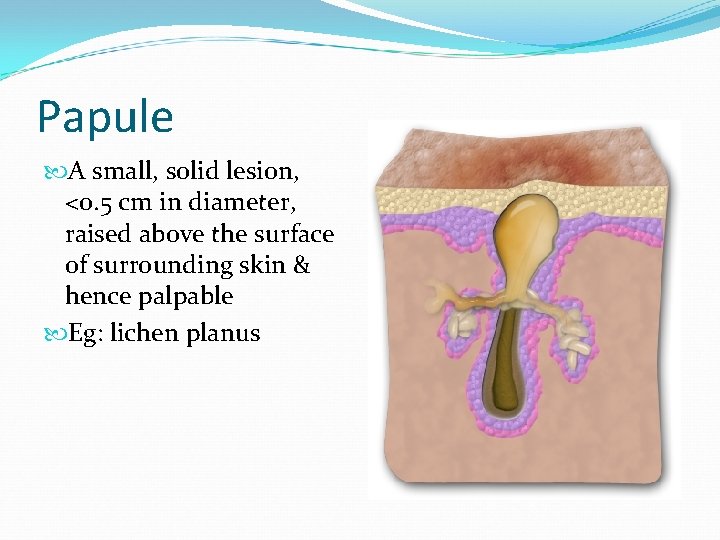 Papule A small, solid lesion, <0. 5 cm in diameter, raised above the surface
