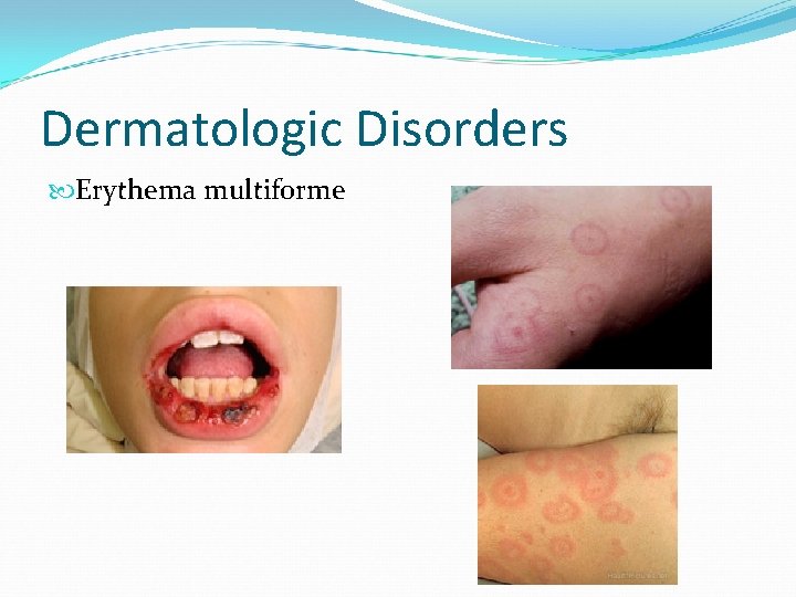 Dermatologic Disorders Erythema multiforme 