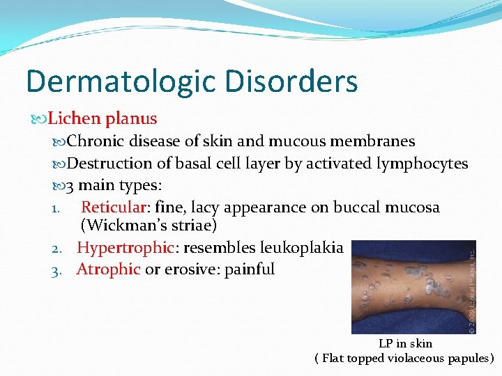 Dermatologic Disorders Lichen planus Chronic disease of skin and mucous membranes Destruction of basal