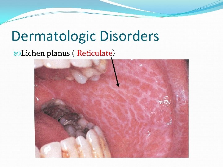Dermatologic Disorders Lichen planus ( Reticulate) 