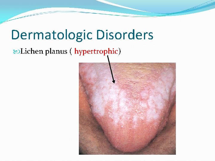 Dermatologic Disorders Lichen planus ( hypertrophic) 