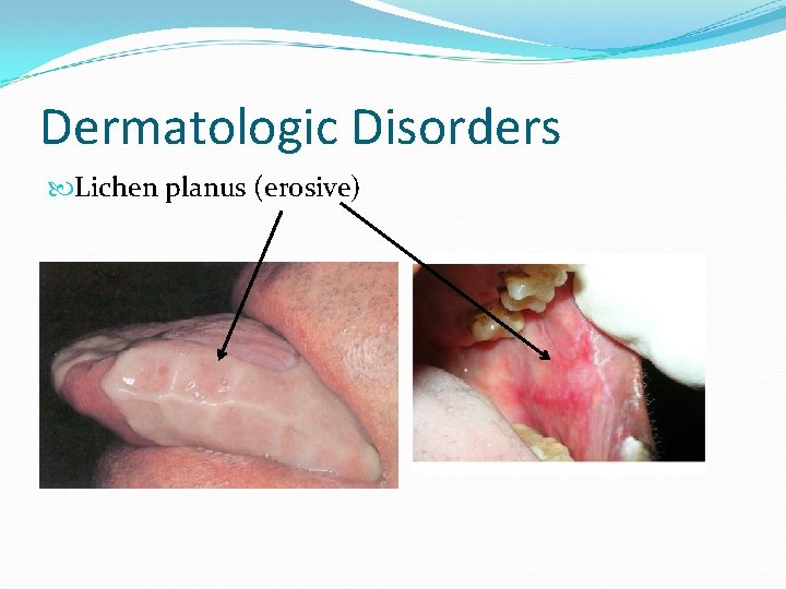 Dermatologic Disorders Lichen planus (erosive) 