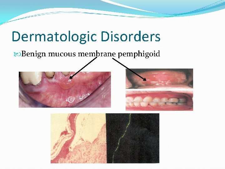 Dermatologic Disorders Benign mucous membrane pemphigoid 