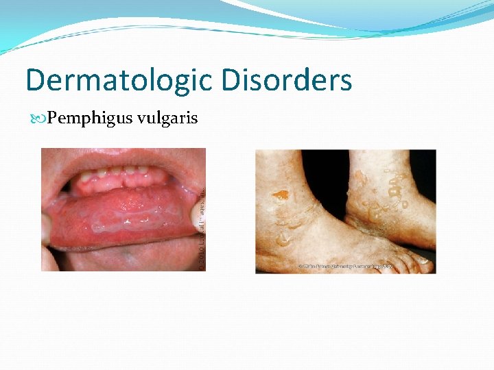 Dermatologic Disorders Pemphigus vulgaris 