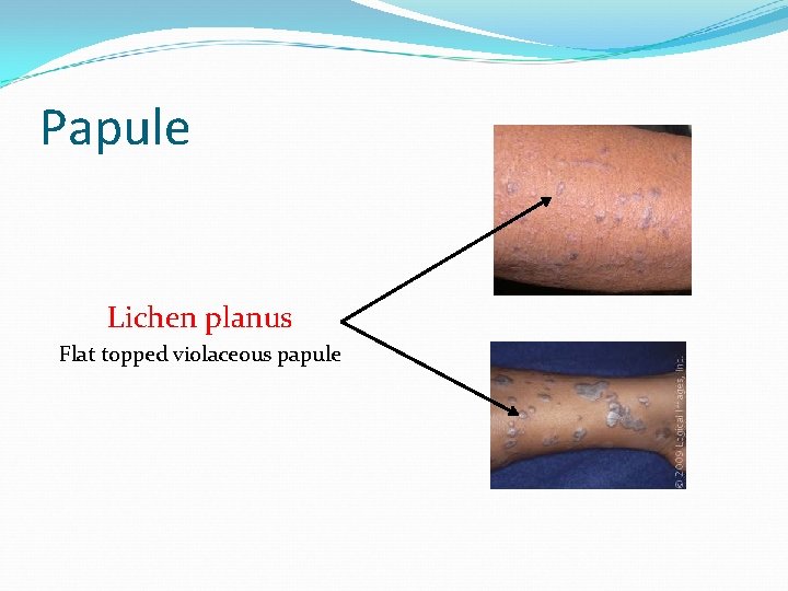 Papule Lichen planus Flat topped violaceous papule 