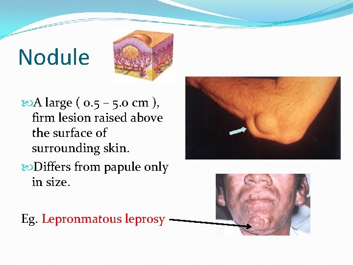 Nodule A large ( 0. 5 – 5. 0 cm ), firm lesion raised