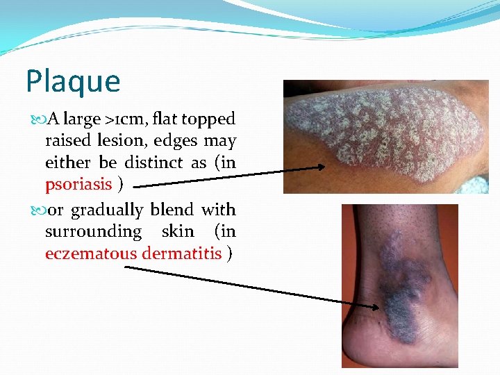 Plaque A large >1 cm, flat topped raised lesion, edges may either be distinct