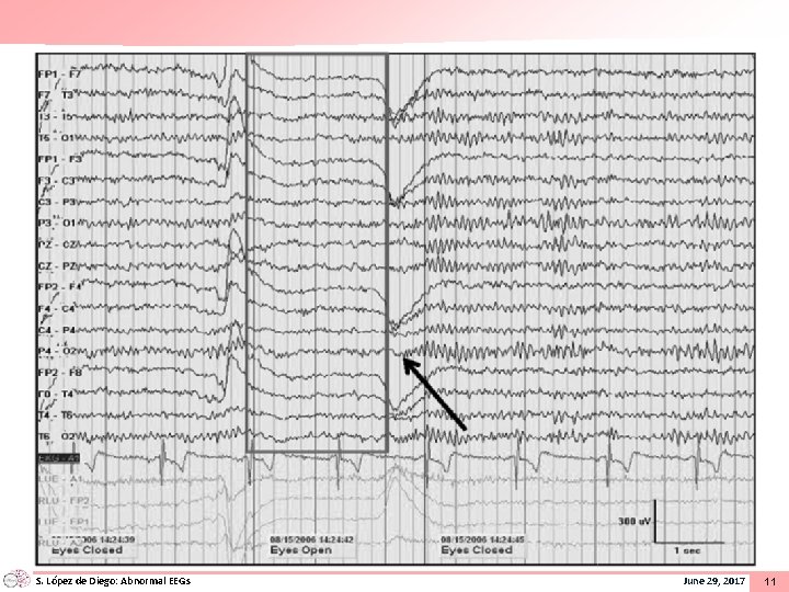 S. López de Diego: Abnormal EEGs June 29, 2017 11 