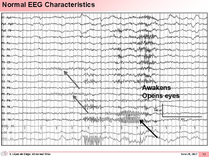 Normal EEG Characteristics S. López de Diego: Abnormal EEGs June 29, 2017 13 