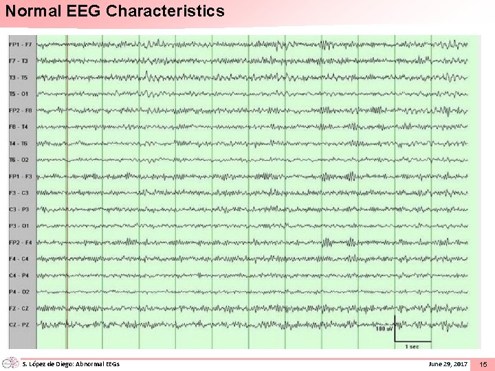 Normal EEG Characteristics S. López de Diego: Abnormal EEGs June 29, 2017 15 