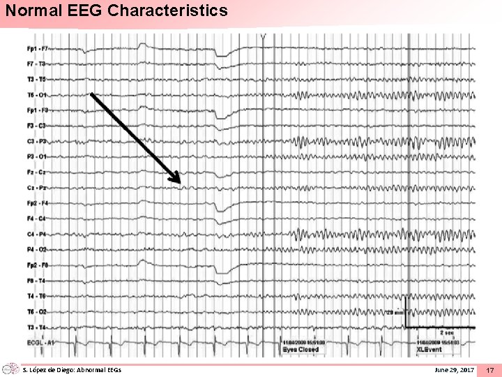 Normal EEG Characteristics S. López de Diego: Abnormal EEGs June 29, 2017 17 